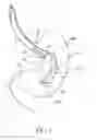 Fig. 02 - Intragastric space filler