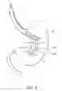 Fig. 05 - Intragastric space filler