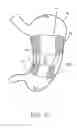 Fig. 11 - Intragastric space filler