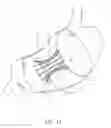 Fig. 14 - Intragastric space filler