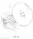 Fig. 15 - Intragastric space filler