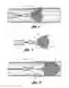 Fig. 02 - Embolic protection device having a filter