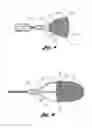 Fig. 05 - Embolic protection device having a filter