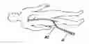 Fig. 01 - Devices and methods for transluminal or transthoracic interstitial electrode placement