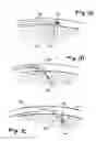 Fig. 02 - Devices and methods for transluminal or transthoracic interstitial electrode placement