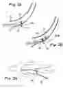 Fig. 03 - Devices and methods for transluminal or transthoracic interstitial electrode placement
