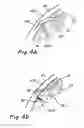 Fig. 05 - Devices and methods for transluminal or transthoracic interstitial electrode placement