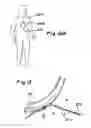 Fig. 07 - Devices and methods for transluminal or transthoracic interstitial electrode placement