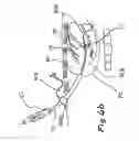Fig. 08 - Devices and methods for transluminal or transthoracic interstitial electrode placement
