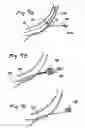 Fig. 10 - Devices and methods for transluminal or transthoracic interstitial electrode placement