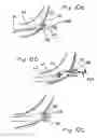 Fig. 11 - Devices and methods for transluminal or transthoracic interstitial electrode placement