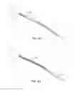 Fig. 06 - Indirect-release electrolytic implant delivery systems