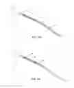 Fig. 08 - Indirect-release electrolytic implant delivery systems