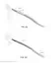 Fig. 06 - Indirect-release electrolytic implant delivery systems