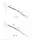 Fig. 08 - Indirect-release electrolytic implant delivery systems