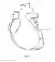 Fig. 02 - Pass-through restraint electrolytic implant delivery systems
