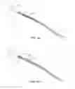 Fig. 05 - Pass-through restraint electrolytic implant delivery systems