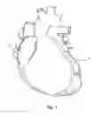 Fig. 02 - Guided stent delivery systems of minimal diameter