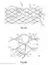 Fig. 03 - Guided stent delivery systems of minimal diameter