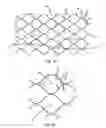 Fig. 04 - Guided stent delivery systems of minimal diameter