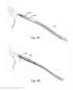 Fig. 07 - Guided stent delivery systems of minimal diameter
