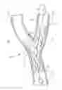 Fig. 01 - Noncylindrical stent deployment system for treating vascular bifurcations