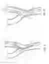 Fig. 04 - Noncylindrical stent deployment system for treating vascular bifurcations