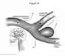 Fig. 13 - Medical device