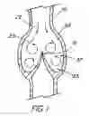 Fig. 02 - Artificial prostheses with preferred geometries