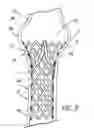 Fig. 06 - Artificial prostheses with preferred geometries