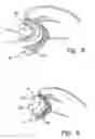 Fig. 04 - Device and method for treatment of mitral insufficiency