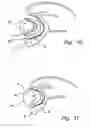 Fig. 05 - Device and method for treatment of mitral insufficiency