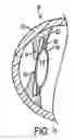 Fig. 04 - Intraocular lens adapted for accommodation via electrical signals
