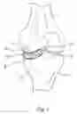 Fig. 02 - Joint spacer implant