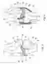 Fig. 04 - Joint spacer implant