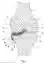 Fig. 05 - Joint spacer implant