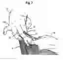 Fig. 08 - Hair-cutting method