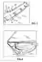 Fig. 05 - Method to control thickness in composite parts cured on closed angle tool
