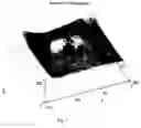 Fig. 08 - Method of bioimage data processing for revealing more meaningful anatomic features of diseased tissues