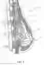 Fig. 03 - Breast stimulation and augmentation system