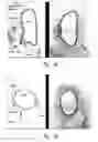 Fig. 08 - Compositions and methods for improving integrity of compromised body passageways and cavities