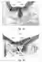 Fig. 09 - Compositions and methods for improving integrity of compromised body passageways and cavities
