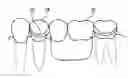 Fig. 01 - Prosthesis-fixing structure and prosthesis-fixing method