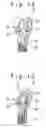 Fig. 07 - Prosthesis-fixing structure and prosthesis-fixing method