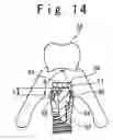 Fig. 08 - Prosthesis-fixing structure and prosthesis-fixing method