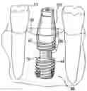 Fig. 01 - Combination distraction dental implant and method of use