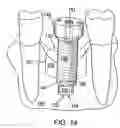 Fig. 10 - Combination distraction dental implant and method of use