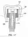 Fig. 13 - Combination distraction dental implant and method of use