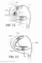 Fig. 07 - Golf club head having movable weights