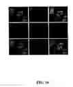 Fig. 17 - Methods for achieving a protective ACE2 expression level to treat kidney disease and hypertension